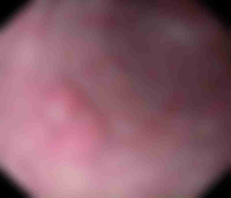 EMR Early Gastric Cancer
